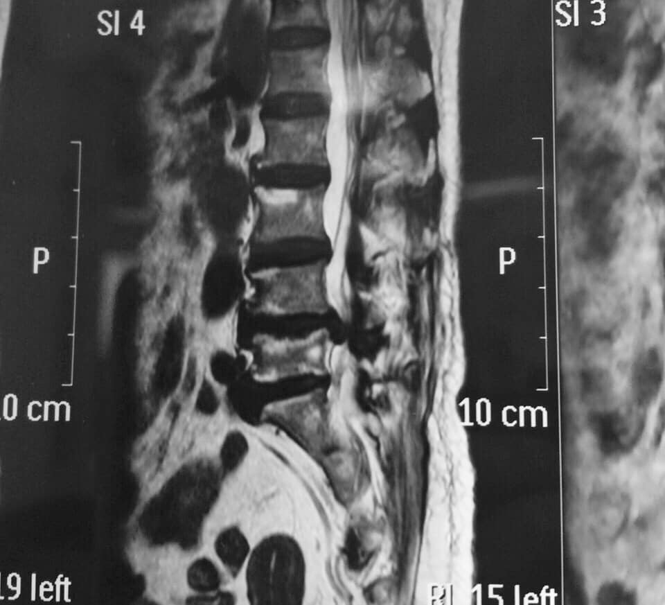 Thoát vị đĩa đệm cột sống thắt lưng